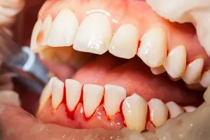 Bleeding Gums